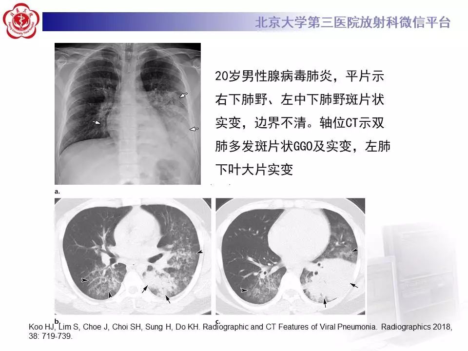 【病例】甲型流感性病毒性肺炎1例CT影像表现