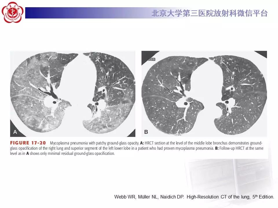 【病例】甲型流感性病毒性肺炎1例CT影像表现