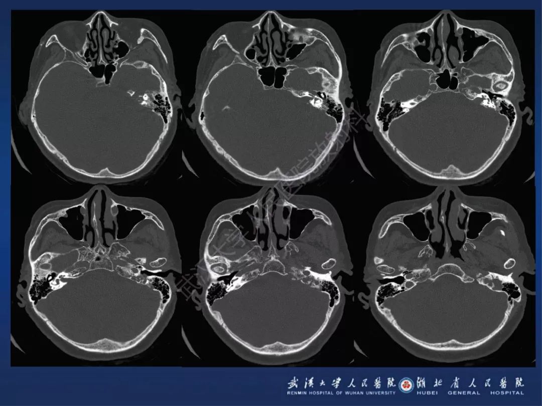 【PPT】耳内淋巴囊肿瘤影像诊断