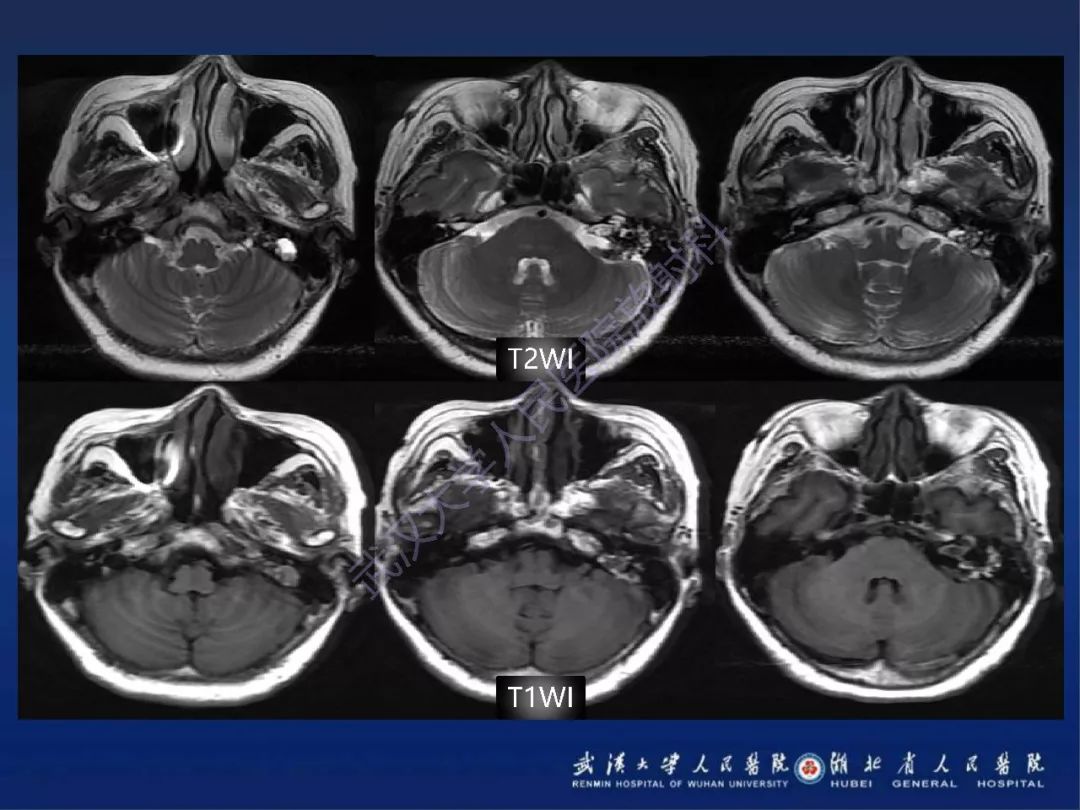 【PPT】耳内淋巴囊肿瘤影像诊断