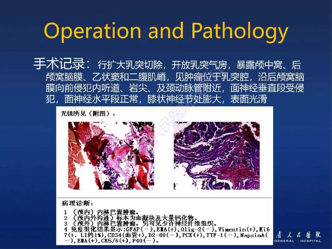 【PPT】耳内淋巴囊肿瘤影像诊断