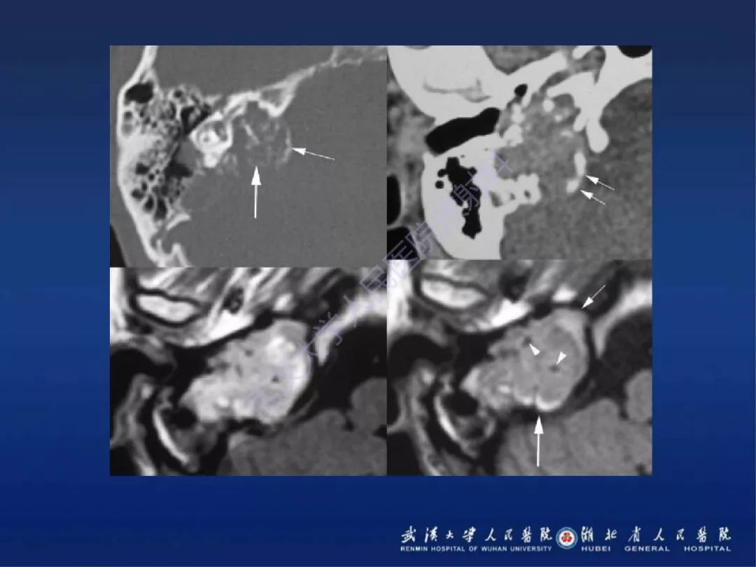 【PPT】耳内淋巴囊肿瘤影像诊断