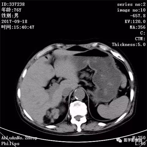 【病例】肾血管平滑肌脂肪瘤1例CT影像表现 【病例】肾血管平滑肌脂肪瘤1例CT影像表现