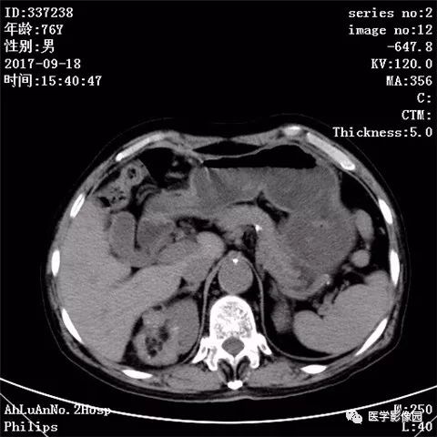【病例】肾血管平滑肌脂肪瘤1例CT影像表现 【病例】肾血管平滑肌脂肪瘤1例CT影像表现