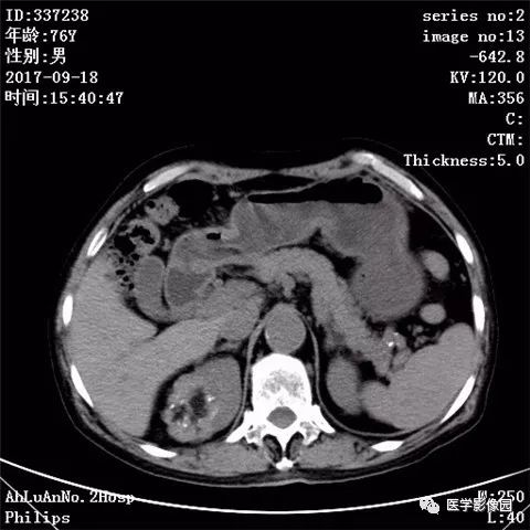 【病例】肾血管平滑肌脂肪瘤1例CT影像表现 【病例】肾血管平滑肌脂肪瘤1例CT影像表现