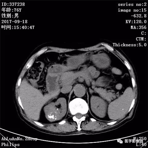 【病例】肾血管平滑肌脂肪瘤1例CT影像表现 【病例】肾血管平滑肌脂肪瘤1例CT影像表现