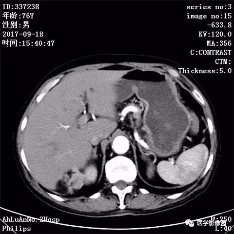 【病例】肾血管平滑肌脂肪瘤1例CT影像表现 【病例】肾血管平滑肌脂肪瘤1例CT影像表现