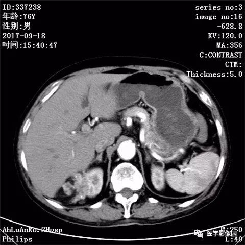 【病例】肾血管平滑肌脂肪瘤1例CT影像表现 【病例】肾血管平滑肌脂肪瘤1例CT影像表现