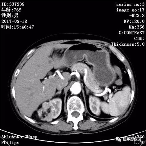【病例】肾血管平滑肌脂肪瘤1例CT影像表现 【病例】肾血管平滑肌脂肪瘤1例CT影像表现