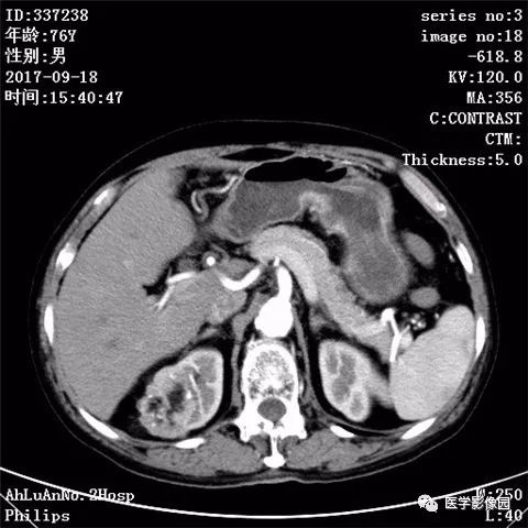 【病例】肾血管平滑肌脂肪瘤1例CT影像表现 【病例】肾血管平滑肌脂肪瘤1例CT影像表现