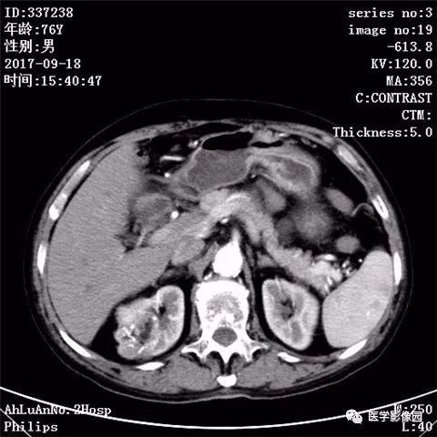 【病例】肾血管平滑肌脂肪瘤1例CT影像表现 【病例】肾血管平滑肌脂肪瘤1例CT影像表现