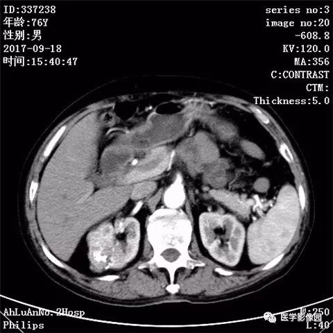 【病例】肾血管平滑肌脂肪瘤1例CT影像表现 【病例】肾血管平滑肌脂肪瘤1例CT影像表现