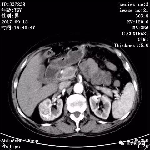 【病例】肾血管平滑肌脂肪瘤1例CT影像表现 【病例】肾血管平滑肌脂肪瘤1例CT影像表现