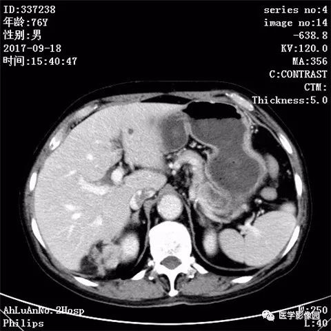【病例】肾血管平滑肌脂肪瘤1例CT影像表现 【病例】肾血管平滑肌脂肪瘤1例CT影像表现