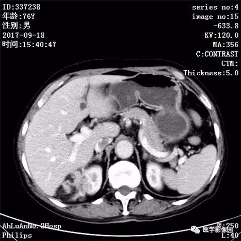 【病例】肾血管平滑肌脂肪瘤1例CT影像表现 【病例】肾血管平滑肌脂肪瘤1例CT影像表现