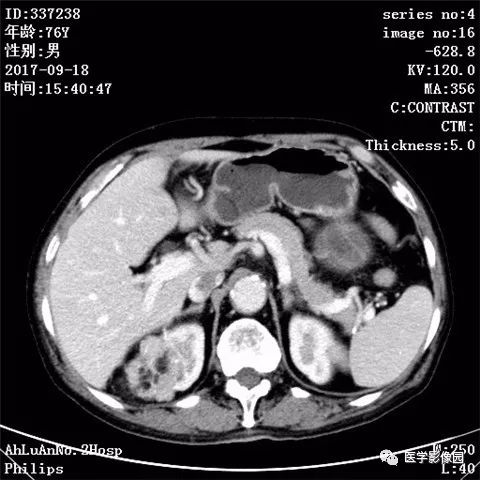 【病例】肾血管平滑肌脂肪瘤1例CT影像表现 【病例】肾血管平滑肌脂肪瘤1例CT影像表现