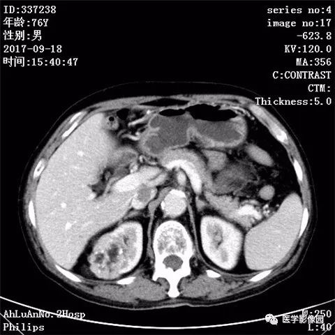 【病例】肾血管平滑肌脂肪瘤1例CT影像表现 【病例】肾血管平滑肌脂肪瘤1例CT影像表现