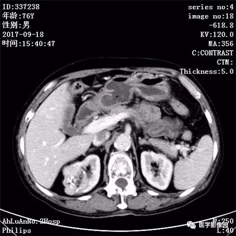 【病例】肾血管平滑肌脂肪瘤1例CT影像表现 【病例】肾血管平滑肌脂肪瘤1例CT影像表现