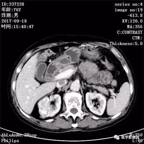 【病例】肾血管平滑肌脂肪瘤1例CT影像表现 【病例】肾血管平滑肌脂肪瘤1例CT影像表现