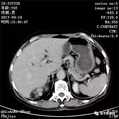 【病例】肾血管平滑肌脂肪瘤1例CT影像表现 【病例】肾血管平滑肌脂肪瘤1例CT影像表现