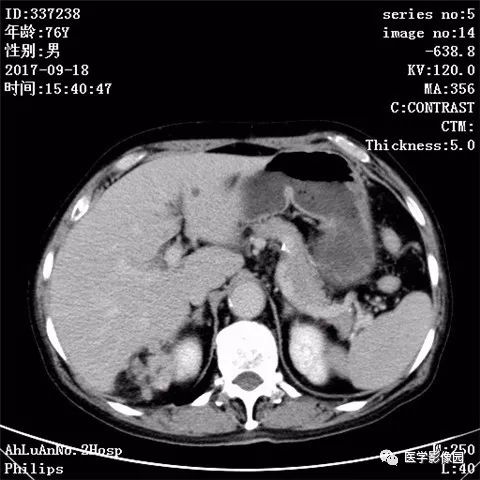 【病例】肾血管平滑肌脂肪瘤1例CT影像表现 【病例】肾血管平滑肌脂肪瘤1例CT影像表现