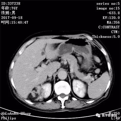 【病例】肾血管平滑肌脂肪瘤1例CT影像表现 【病例】肾血管平滑肌脂肪瘤1例CT影像表现