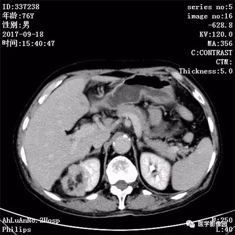 【病例】肾血管平滑肌脂肪瘤1例CT影像表现 【病例】肾血管平滑肌脂肪瘤1例CT影像表现