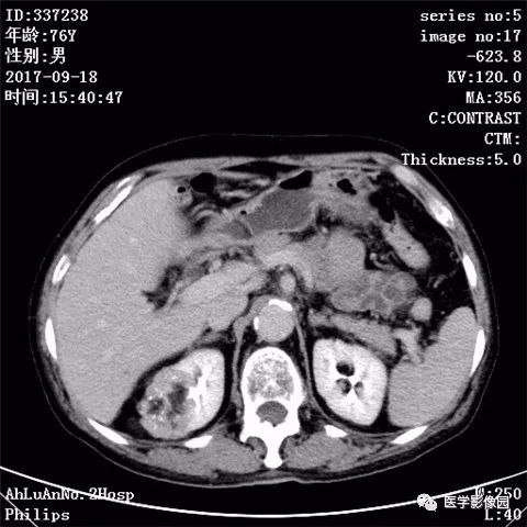 【病例】肾血管平滑肌脂肪瘤1例CT影像表现 【病例】肾血管平滑肌脂肪瘤1例CT影像表现