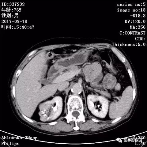 【病例】肾血管平滑肌脂肪瘤1例CT影像表现 【病例】肾血管平滑肌脂肪瘤1例CT影像表现