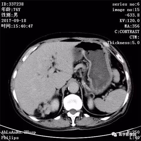 【病例】肾血管平滑肌脂肪瘤1例CT影像表现 【病例】肾血管平滑肌脂肪瘤1例CT影像表现