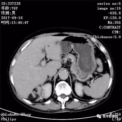 【病例】肾血管平滑肌脂肪瘤1例CT影像表现 【病例】肾血管平滑肌脂肪瘤1例CT影像表现