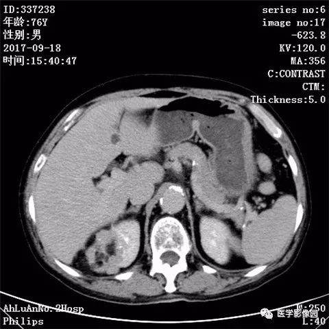 【病例】肾血管平滑肌脂肪瘤1例CT影像表现 【病例】肾血管平滑肌脂肪瘤1例CT影像表现