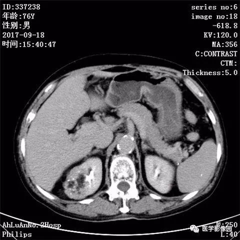 【病例】肾血管平滑肌脂肪瘤1例CT影像表现 【病例】肾血管平滑肌脂肪瘤1例CT影像表现