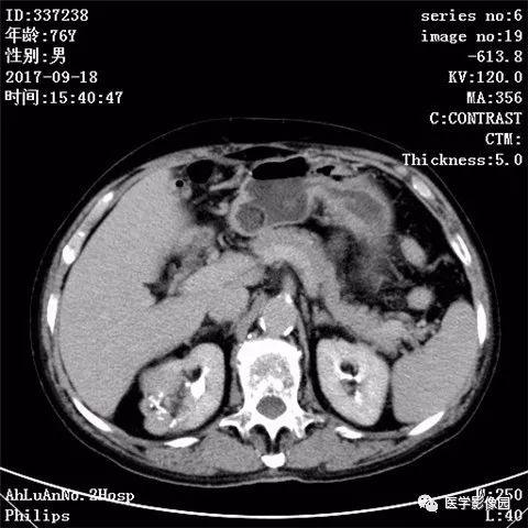 【病例】肾血管平滑肌脂肪瘤1例CT影像表现 【病例】肾血管平滑肌脂肪瘤1例CT影像表现