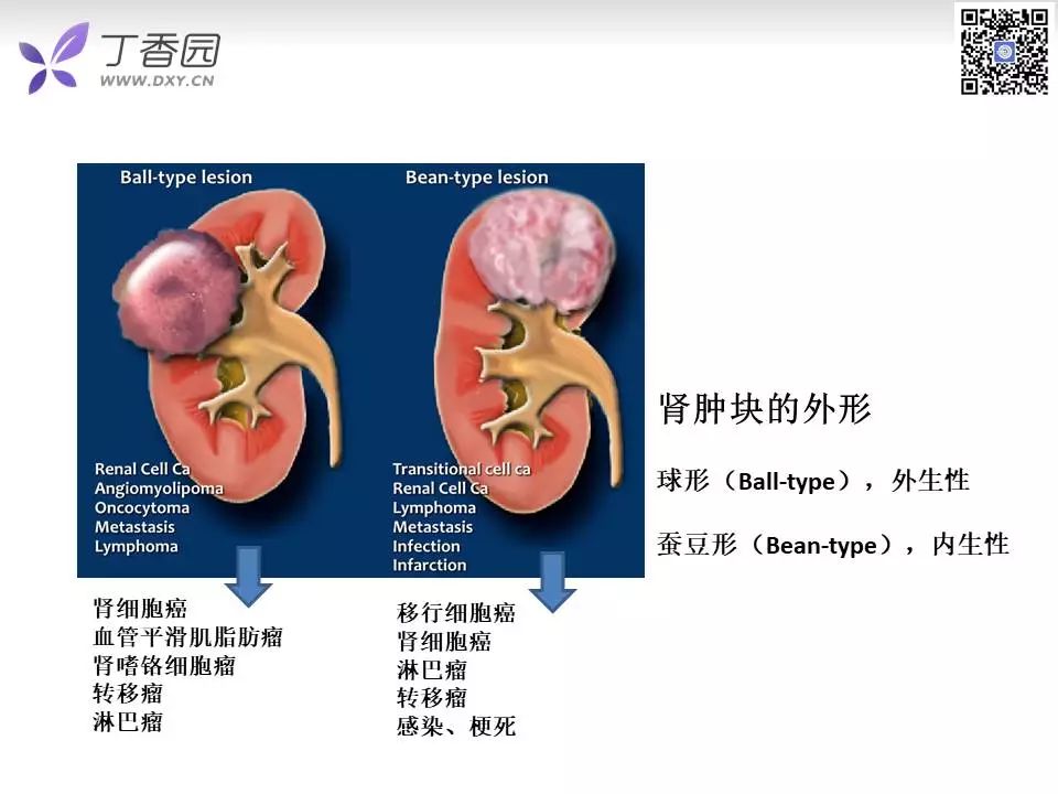 【PPT】肾脏常见肿瘤的影像诊断思路