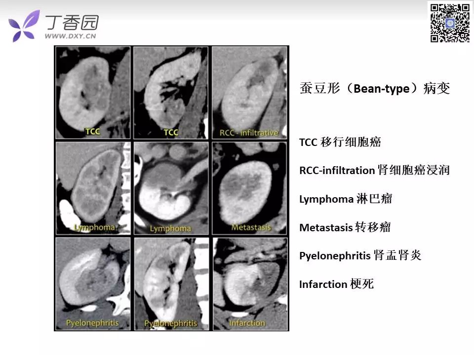 【PPT】肾脏常见肿瘤的影像诊断思路