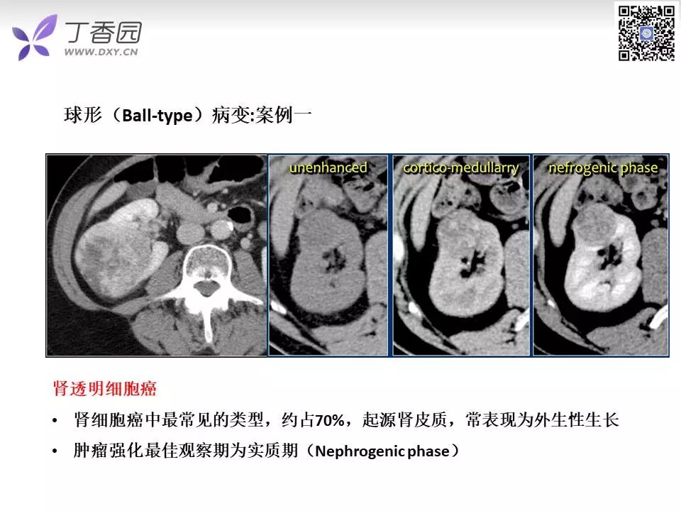 【PPT】肾脏常见肿瘤的影像诊断思路