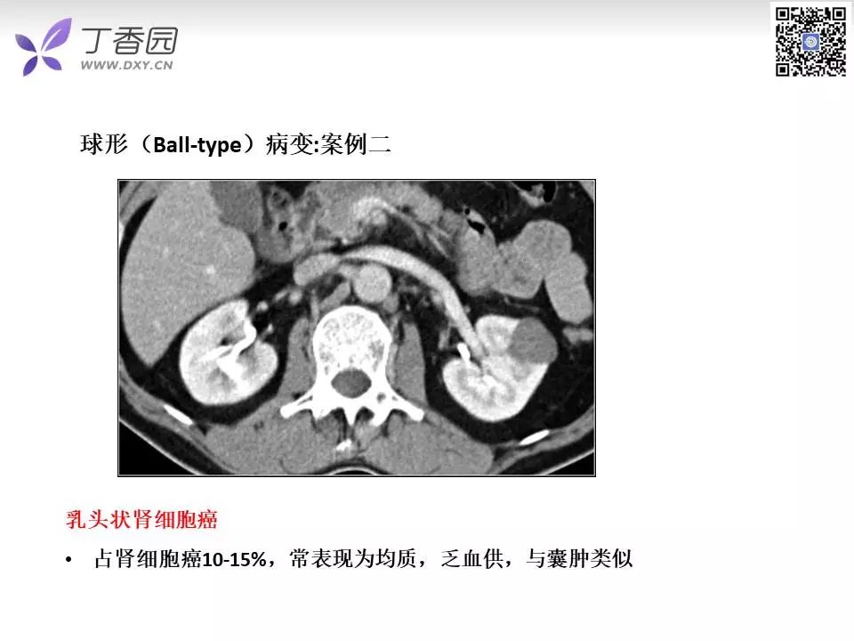 【PPT】肾脏常见肿瘤的影像诊断思路