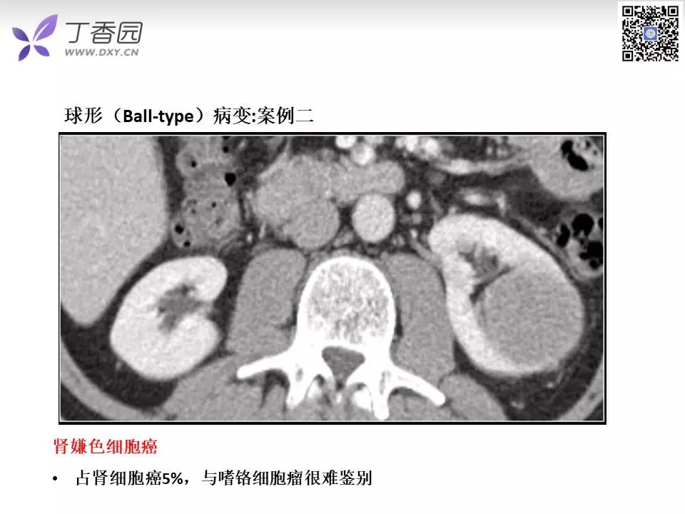 【PPT】肾脏常见肿瘤的影像诊断思路