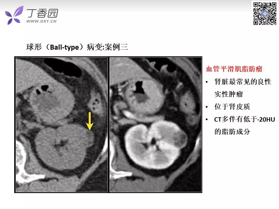 【PPT】肾脏常见肿瘤的影像诊断思路
