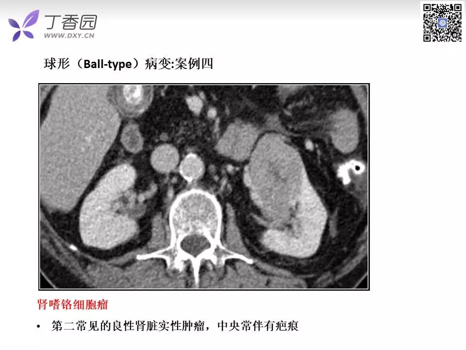 【PPT】肾脏常见肿瘤的影像诊断思路