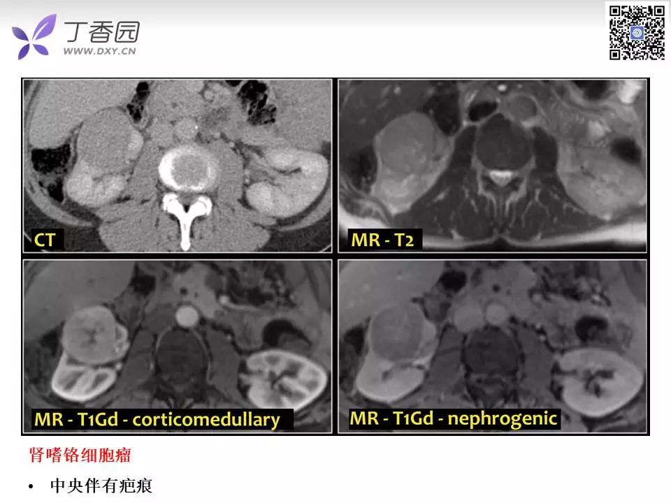 【PPT】肾脏常见肿瘤的影像诊断思路