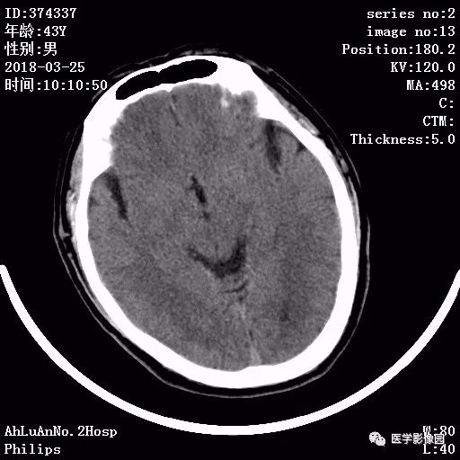 【病例】四脑室毛细胞型星形细胞瘤1例CT及MR 【病例】四脑室毛细胞型星形细胞瘤1例CT及MR