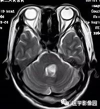 【病例】四脑室毛细胞型星形细胞瘤1例CT及MR 【病例】四脑室毛细胞型星形细胞瘤1例CT及MR