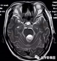 【病例】四脑室毛细胞型星形细胞瘤1例CT及MR 【病例】四脑室毛细胞型星形细胞瘤1例CT及MR