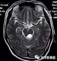 【病例】四脑室毛细胞型星形细胞瘤1例CT及MR 【病例】四脑室毛细胞型星形细胞瘤1例CT及MR