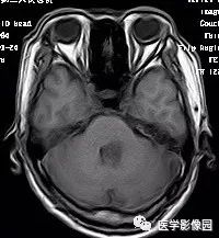 【病例】四脑室毛细胞型星形细胞瘤1例CT及MR 【病例】四脑室毛细胞型星形细胞瘤1例CT及MR