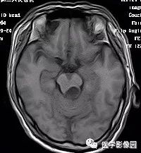 【病例】四脑室毛细胞型星形细胞瘤1例CT及MR 【病例】四脑室毛细胞型星形细胞瘤1例CT及MR