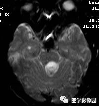【病例】四脑室毛细胞型星形细胞瘤1例CT及MR 【病例】四脑室毛细胞型星形细胞瘤1例CT及MR