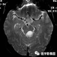 【病例】四脑室毛细胞型星形细胞瘤1例CT及MR 【病例】四脑室毛细胞型星形细胞瘤1例CT及MR